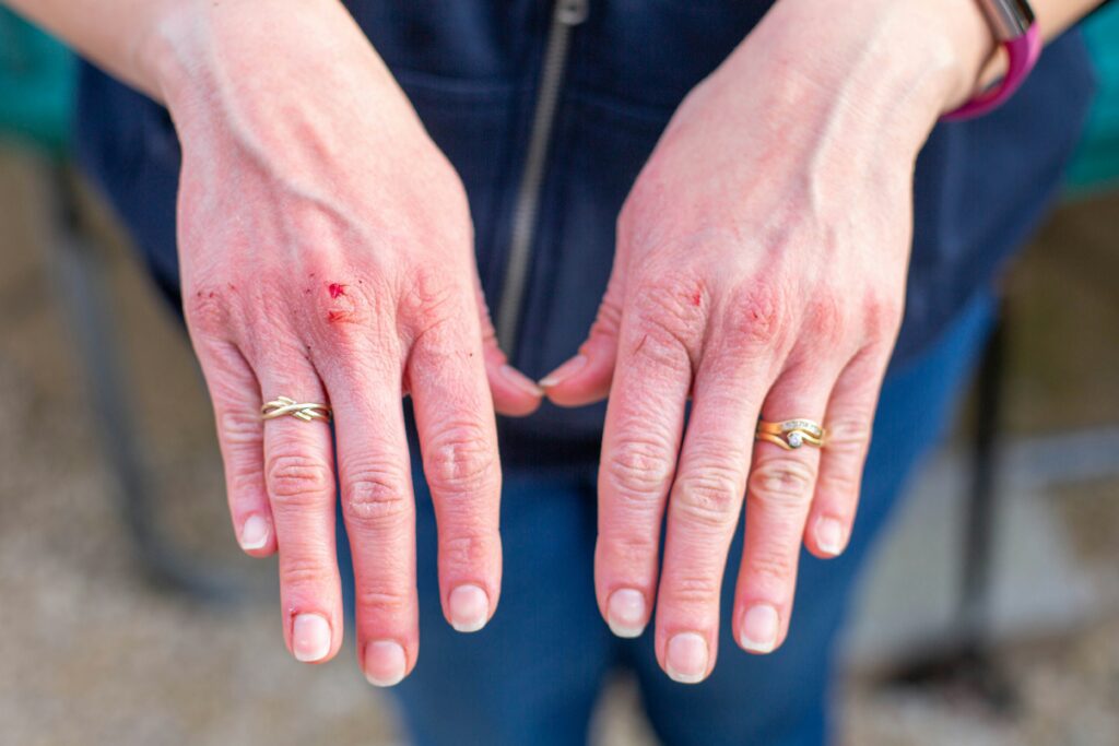 Common Cold and Seasonal Allergies - The Itch Factor
